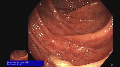 Sample image from Fine Grained Polyp