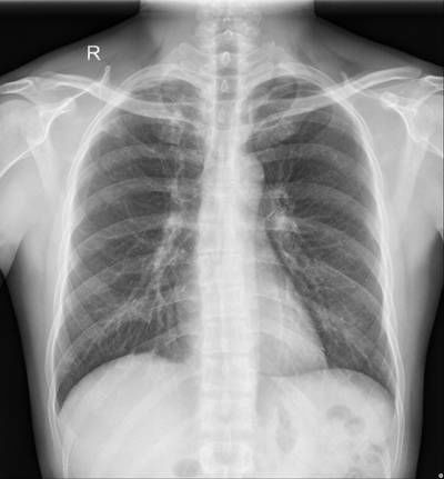 Sample image from Chest Xray Masks and Labels