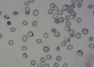 Sample image from P. Vivax (Malaria) Infected Human Blood Smears