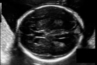 Sample image from Fetal Head UltraSound