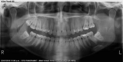 Sample image from Teeth Segmentation on Dental X-ray Images