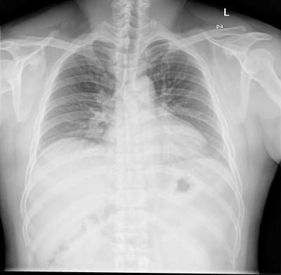 Sample image from Chest Xray Masks and Labels