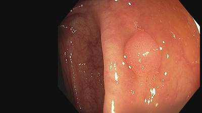 Sample image from Fine Grained Polyp
