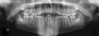 Sample image from Panoramic Dental X-rays