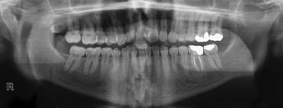 Sample image from Panoramic Dental X-rays