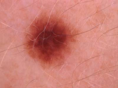 Sample image from Skin Cancer: HAM10000