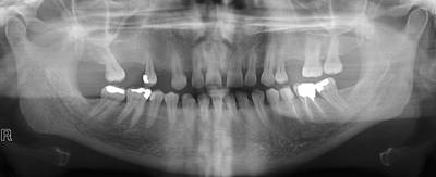 Sample image from Panoramic Dental X-rays