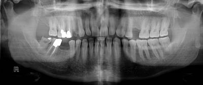 Sample image from Panoramic Dental X-rays