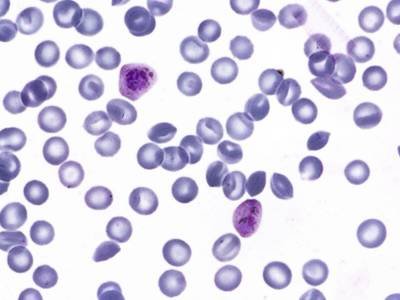 Sample image from P. Vivax (Malaria) Infected Human Blood Smears