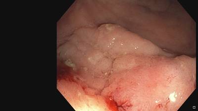 Sample image from Fine Grained Polyp