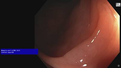 Sample image from Fine Grained Polyp