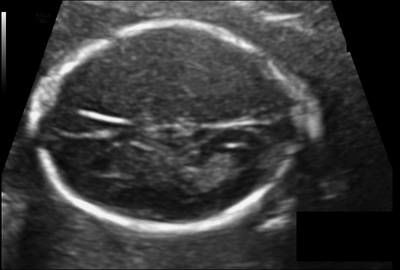 Sample image from Fetal Head UltraSound