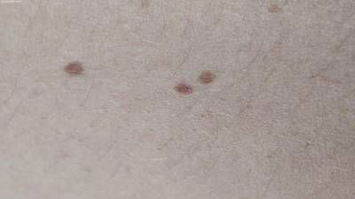Sample image from Accurate Nevus Shapes