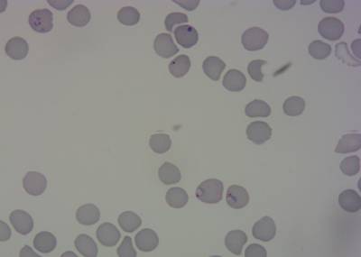 Sample image from P. Vivax (Malaria) Infected Human Blood Smears