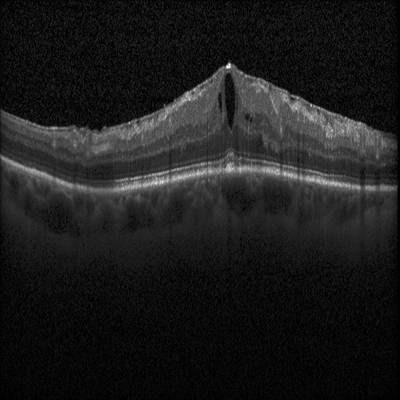 Sample image from Intraretinal Cystoid Fluid
