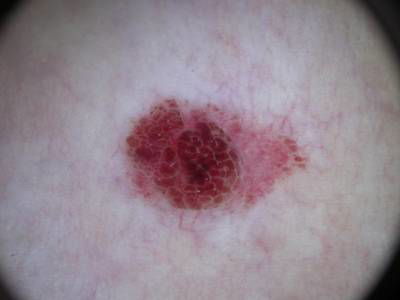 Sample image from Skin Cancer: HAM10000