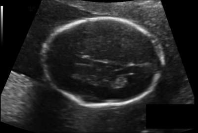 Sample image from Fetal Head UltraSound