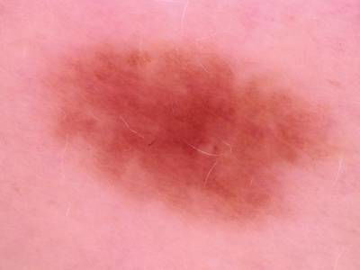 Sample image from Skin Cancer: HAM10000