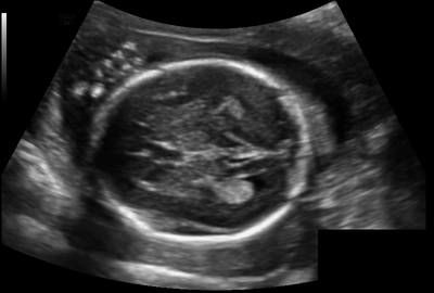 Sample image from Fetal Head UltraSound