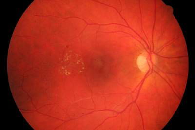 Sample image from High Resolution Fundus