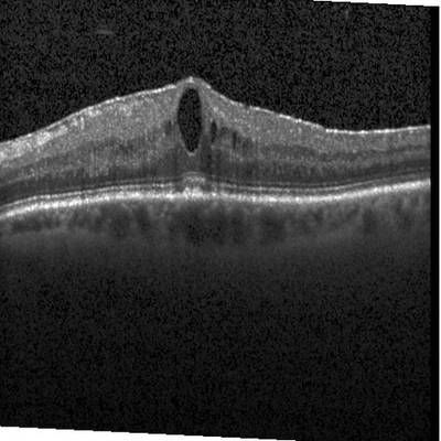 Sample image from Intraretinal Cystoid Fluid