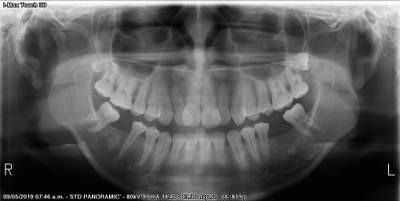 Sample image from Teeth Segmentation on Dental X-ray Images