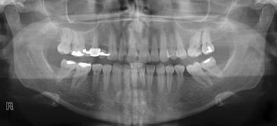 Sample image from Panoramic Dental X-rays