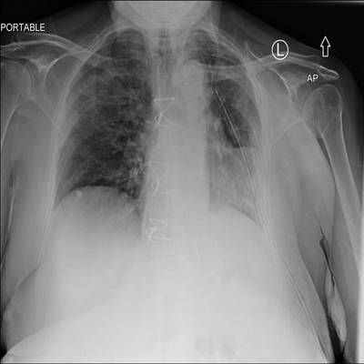 Sample image from SIIM-ACR Pneumothorax Segmentation 2019