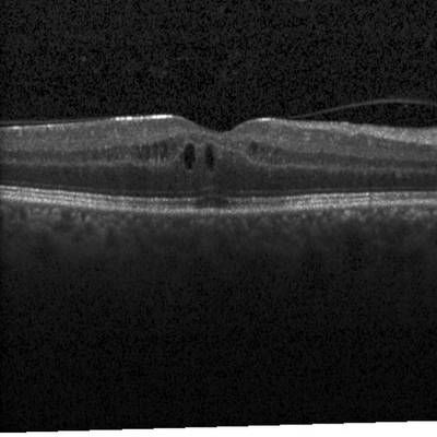 Sample image from Intraretinal Cystoid Fluid