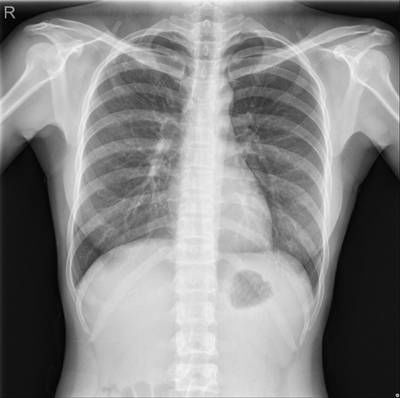 Sample image from Chest Xray Masks and Labels