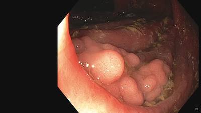 Sample image from Fine Grained Polyp