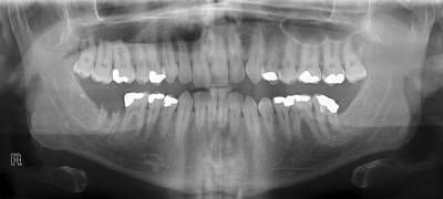 Sample image from Panoramic Dental X-rays