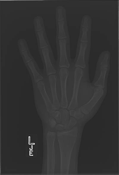 Sample image from RSNA Bone Age 2017