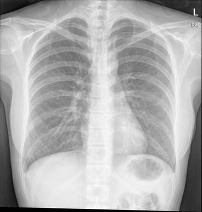 Sample image from Chest Xray Masks and Labels