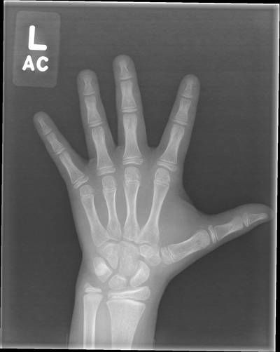 Sample image from RSNA Bone Age 2017