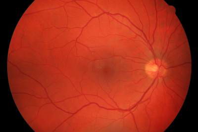 Sample image from High Resolution Fundus