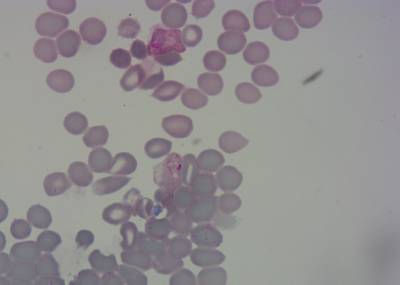 Sample image from P. Vivax (Malaria) Infected Human Blood Smears