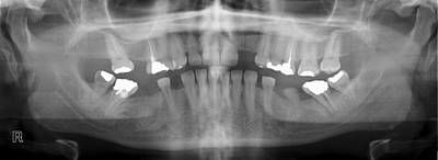 Sample image from Panoramic Dental X-rays