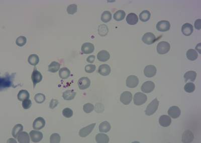 Sample image from P. Vivax (Malaria) Infected Human Blood Smears