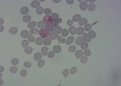 Sample image from P. Vivax (Malaria) Infected Human Blood Smears