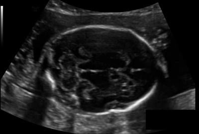 Sample image from Fetal Head UltraSound