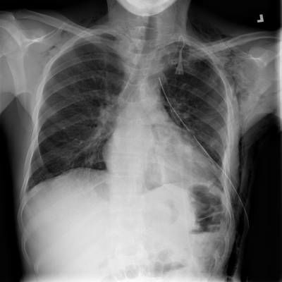Sample image from SIIM-ACR Pneumothorax Segmentation 2019