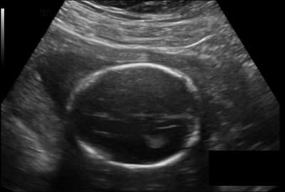 Sample image from Fetal Head UltraSound