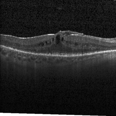 Sample image from Intraretinal Cystoid Fluid