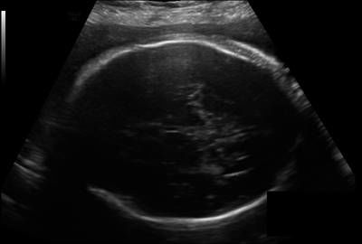 Sample image from Fetal Head UltraSound