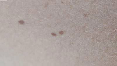 Sample image from Accurate Nevus Shapes