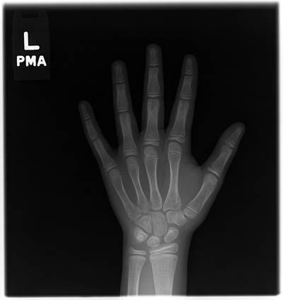 Sample image from RSNA Bone Age 2017