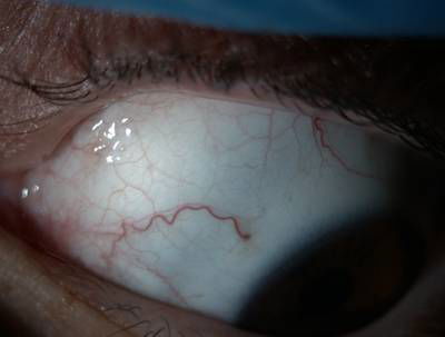 Sample image from Eyes Microcirculation