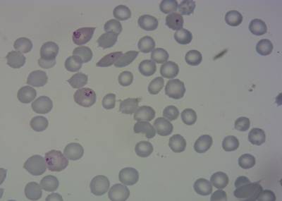 Sample image from P. Vivax (Malaria) Infected Human Blood Smears