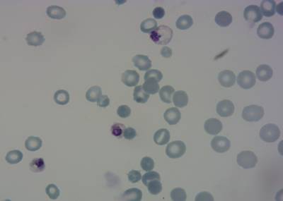 Sample image from P. Vivax (Malaria) Infected Human Blood Smears